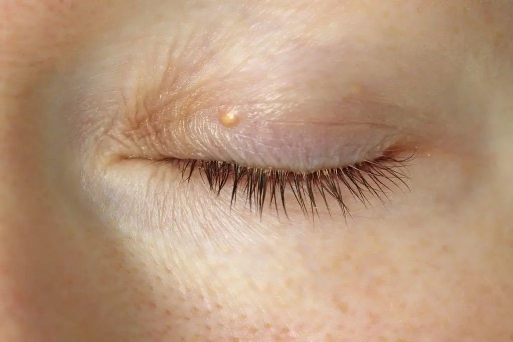נגעים בעפעפיים (EYELID LESIONS) - דוקטור שי קרן