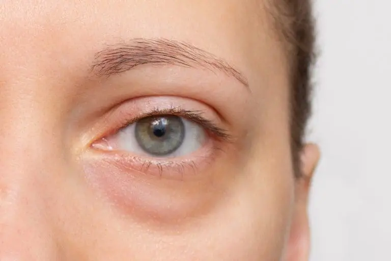 ניתוח הסרת בלט עור (פסטון FESTOON) מתחת לעפעף התחתון - דוקטור שי קרן