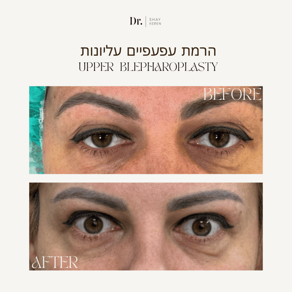 הרמת עפעפיים עליונות לפני ואחרי