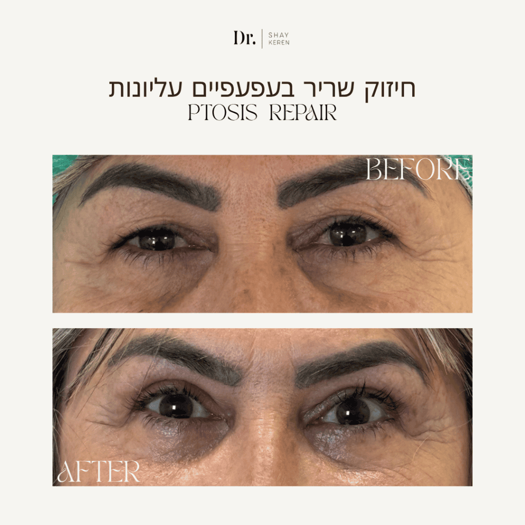 הרמת עפעפיים לפני ואחרי
