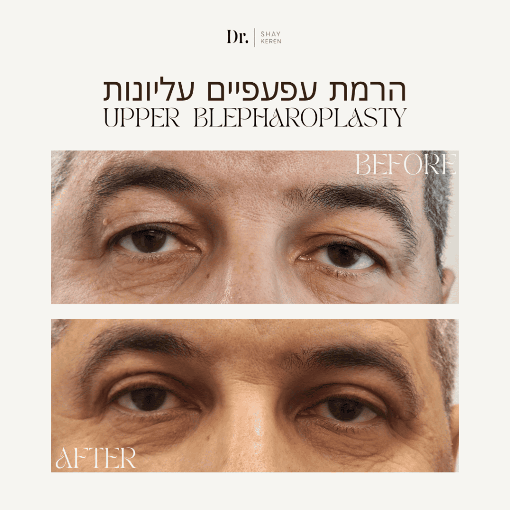 הרמת עפעפיים עליונות לפני ואחרי
