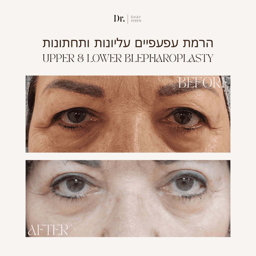הרמת עפעפיים לפני ואחרי